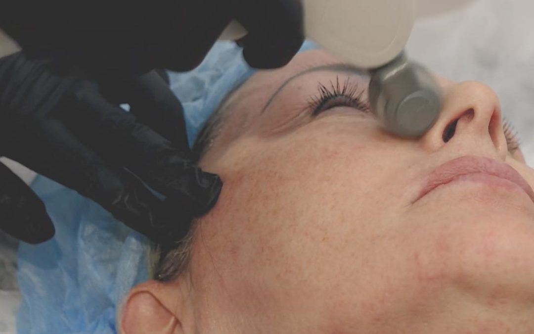 Kerry Receives ALMA SKIN Plus Rejuran